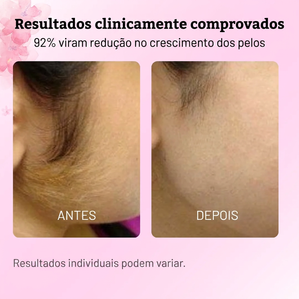Antes e depois com 92% de redução no crescimento dos pelos